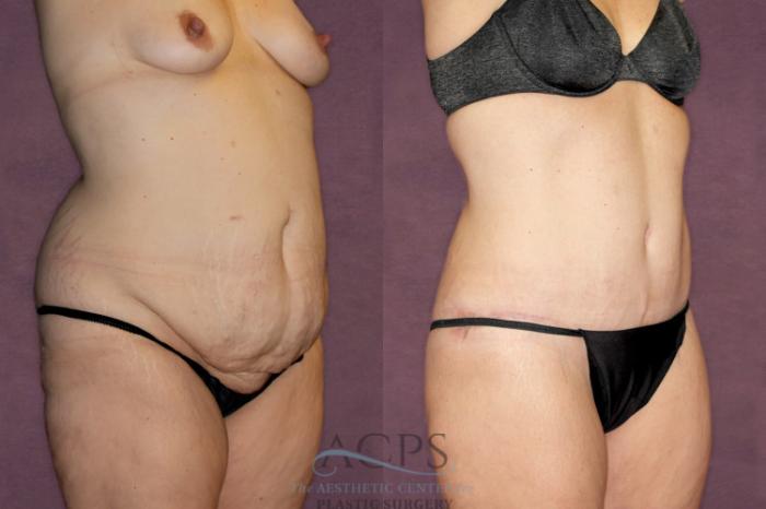 Before & After Liposuction Case 92 Oblique Right View: View in Houston, TX