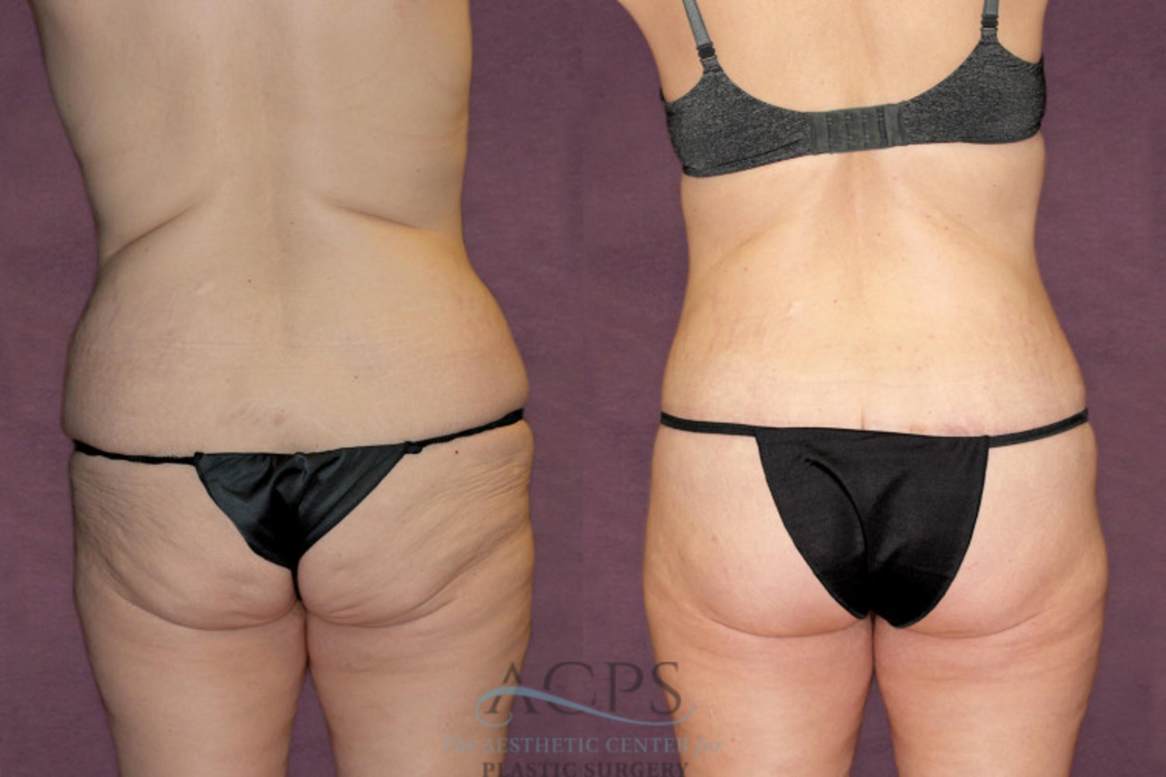 Before & After Liposuction Case 92 Rear View: View in Houston, TX
