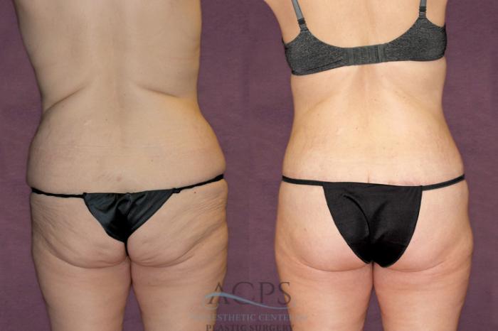 Before & After Liposuction Case 92 Rear View: View in Houston, TX