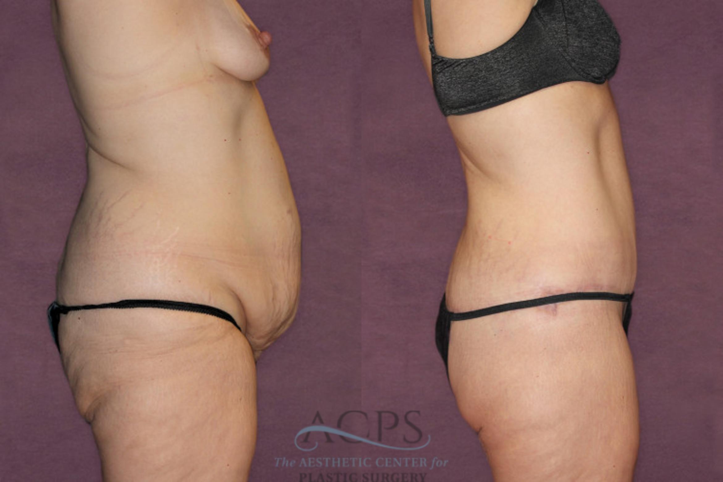 Before & After Liposuction Case 92 Side Right View: View in Houston, TX