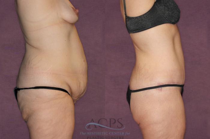Before & After Liposuction Case 92 Side Right View: View in Houston, TX