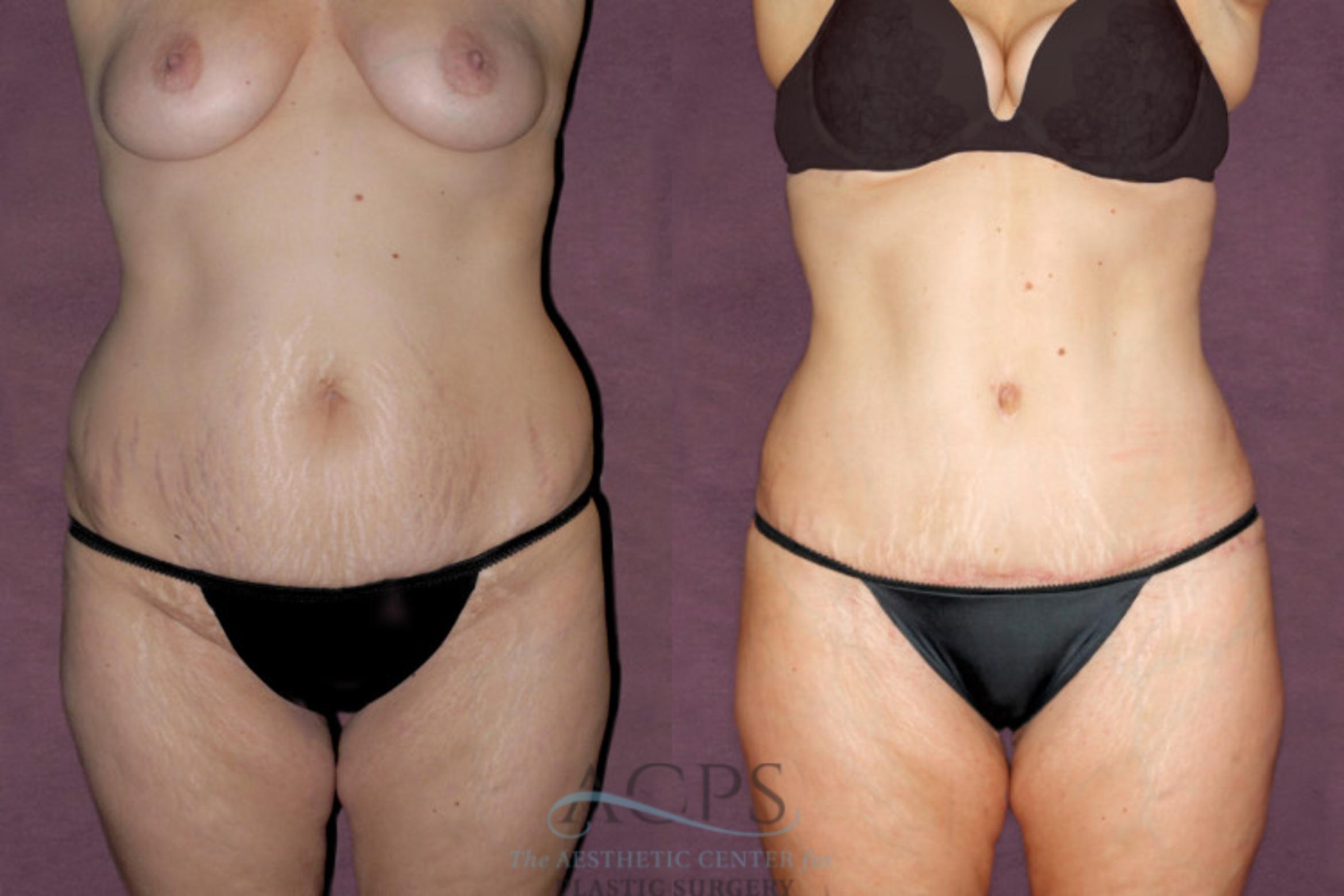 Before & After Tummy Tuck Case 93 Front View: View in Houston, TX