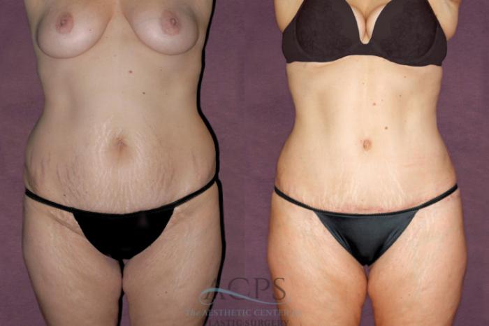 Before & After Tummy Tuck Case 93 Front View: View in Houston, TX