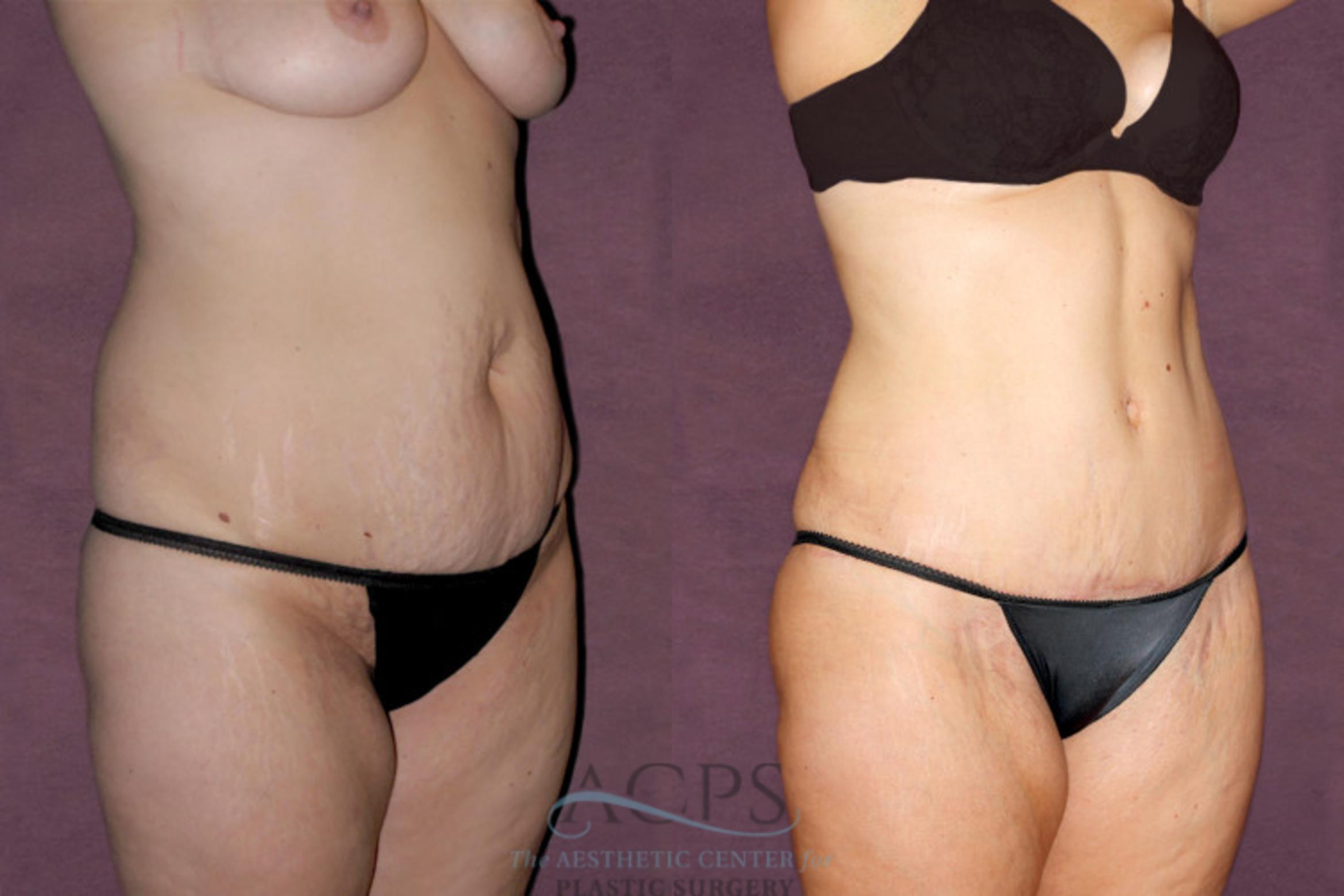 Before & After Tummy Tuck Case 93 Oblique Right View: View in Houston, TX
