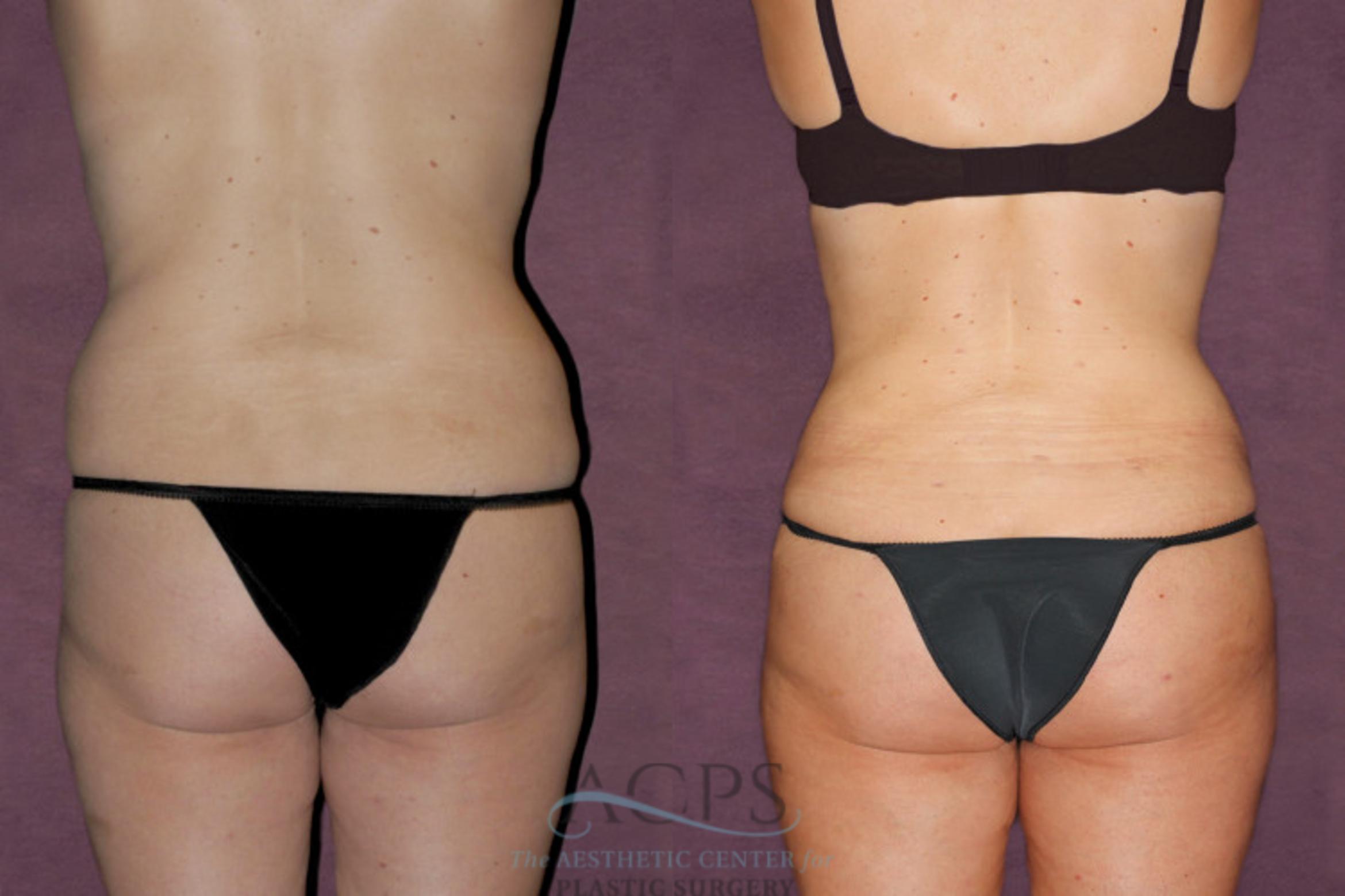 Before & After Tummy Tuck Case 93 Rear View: View in Houston, TX