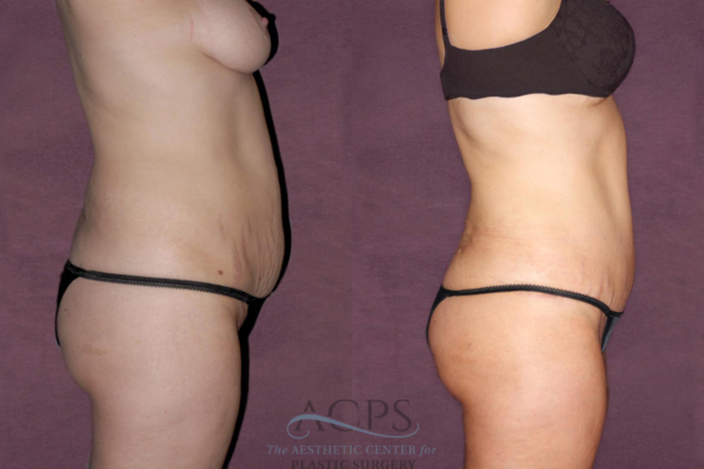 Before & After Tummy Tuck Case 93 Side Right View: View in Houston, TX