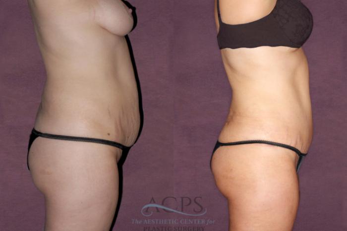 Before & After Tummy Tuck Case 93 Side Right View: View in Houston, TX