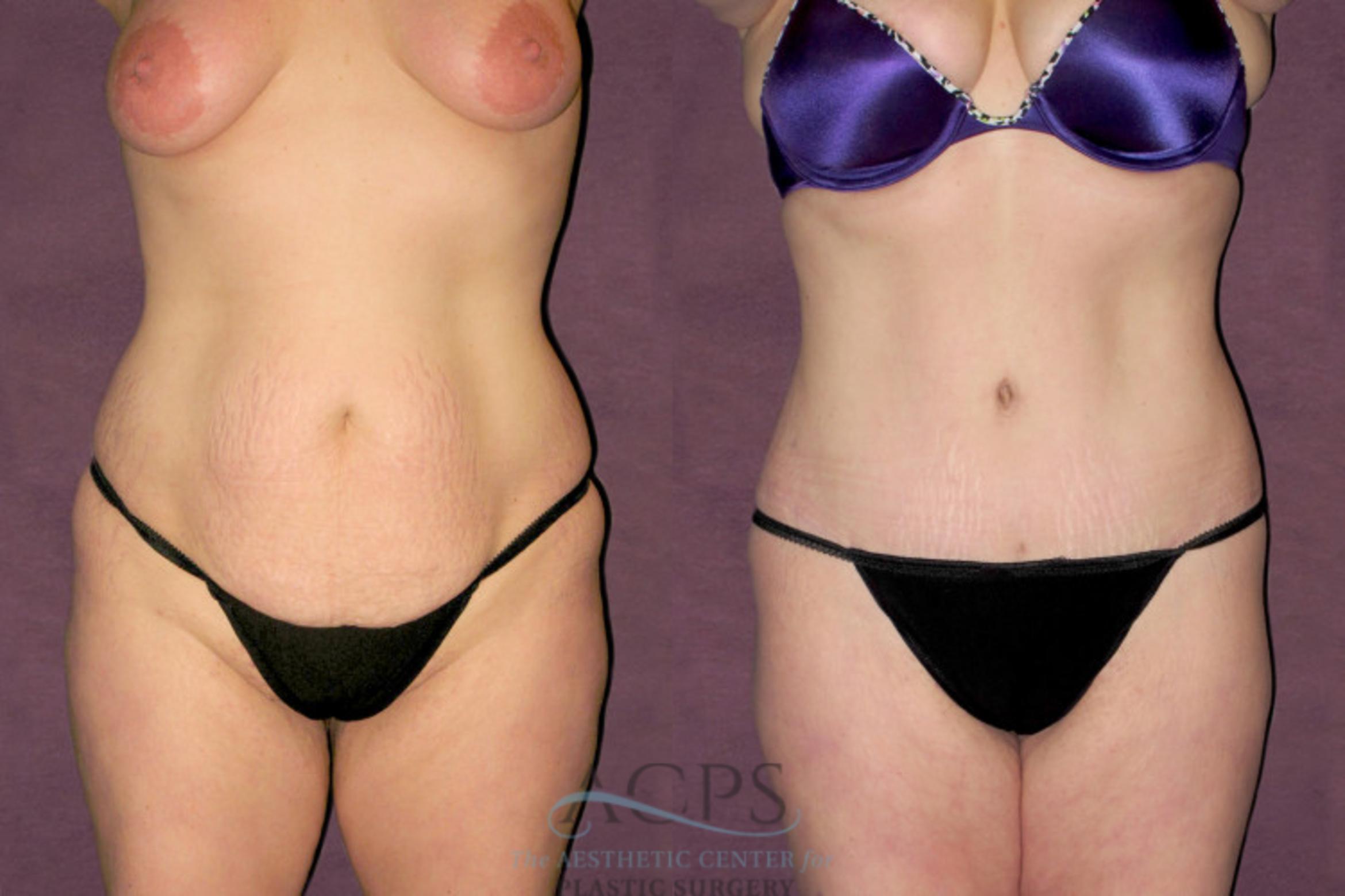 Before & After Liposuction Case 94 Front View: View in Houston, TX