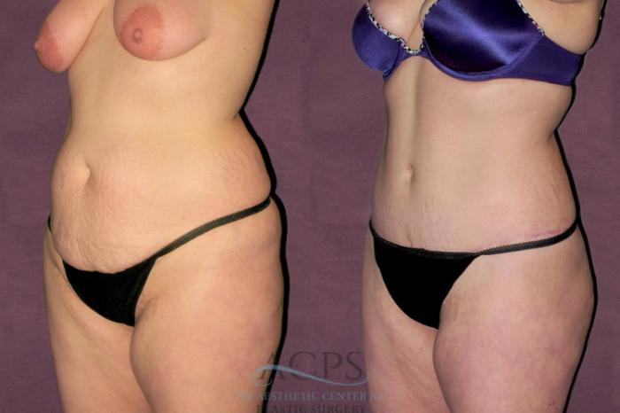 Before & After Liposuction Case 94 Oblique Left View: View in Houston, TX