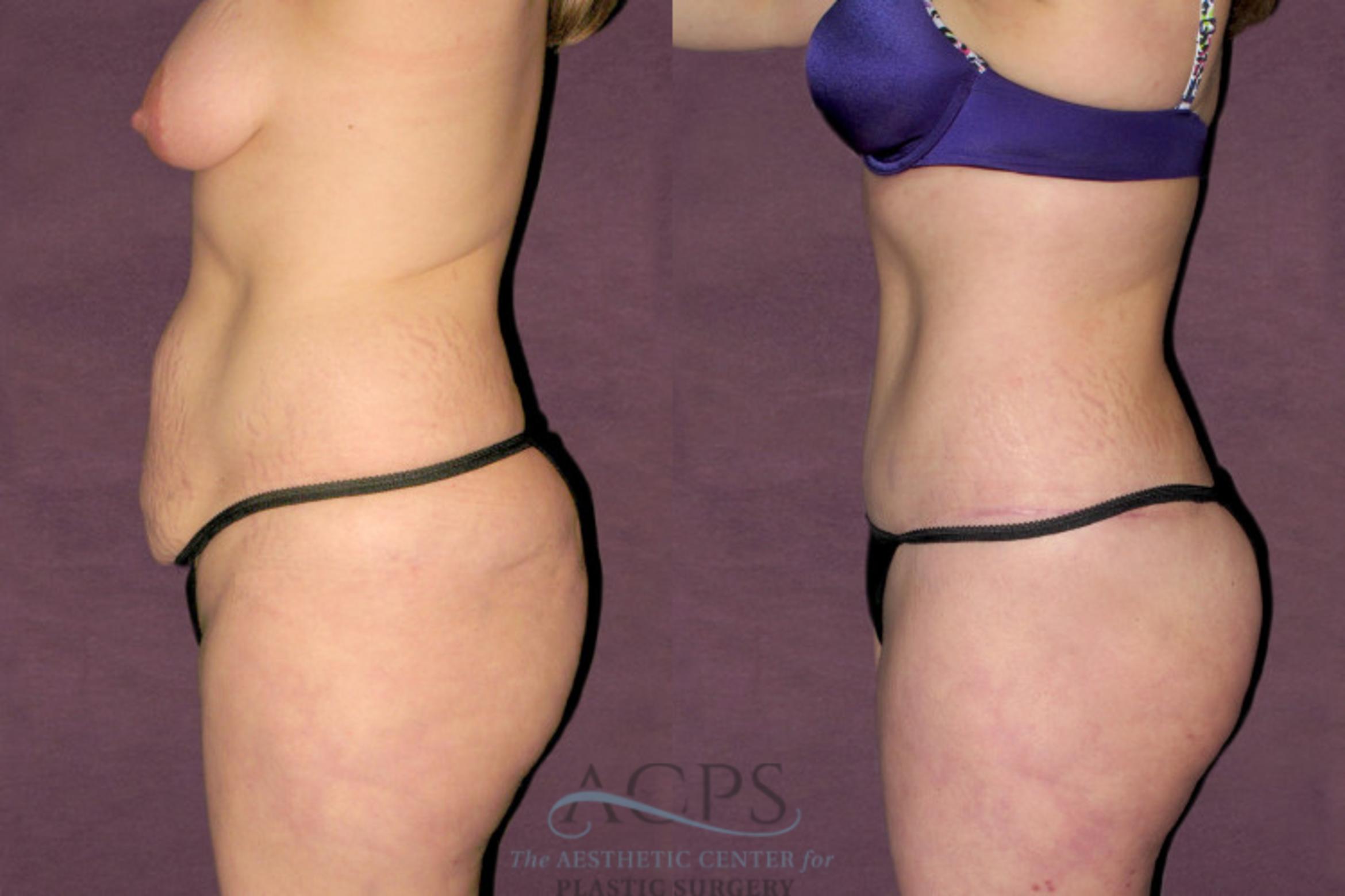 Before & After Liposuction Case 94 Side Left View: View in Houston, TX