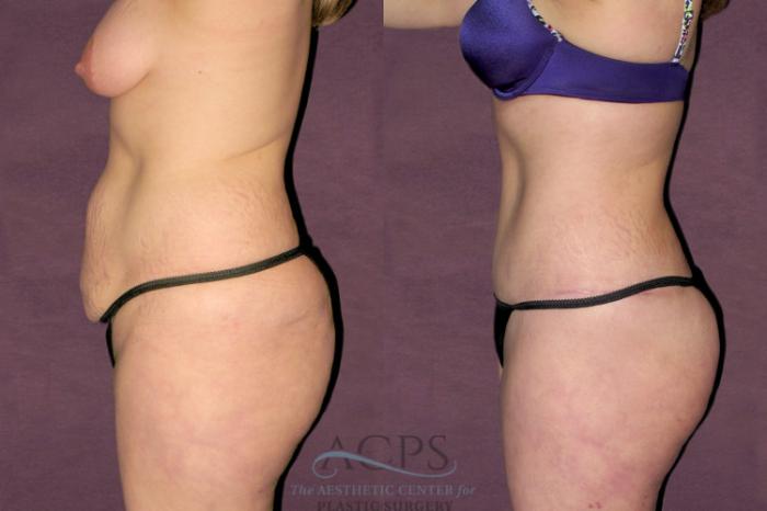 Before & After Liposuction Case 94 Side Left View: View in Houston, TX