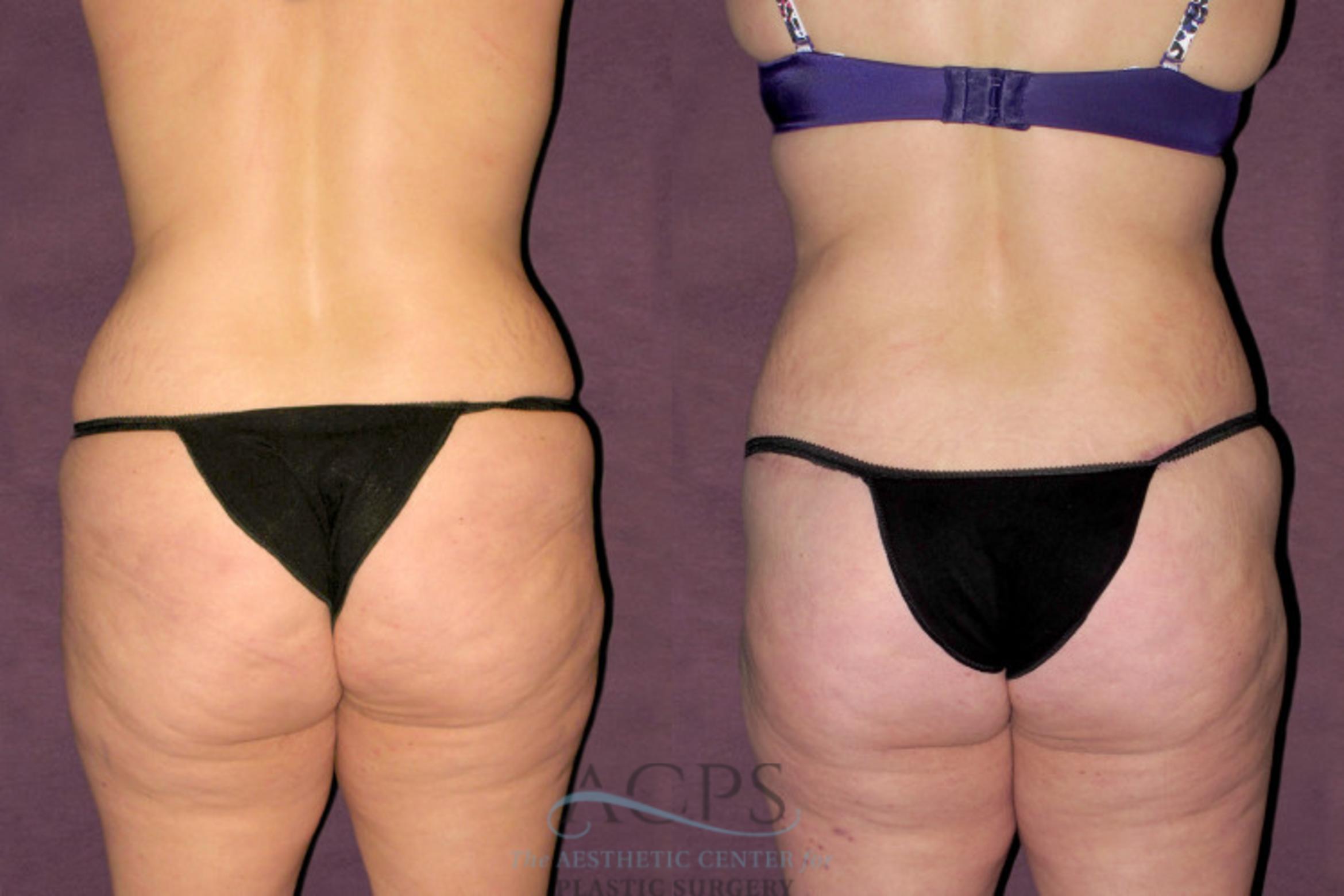 Before & After Liposuction Case 94 View: View in Houston, TX