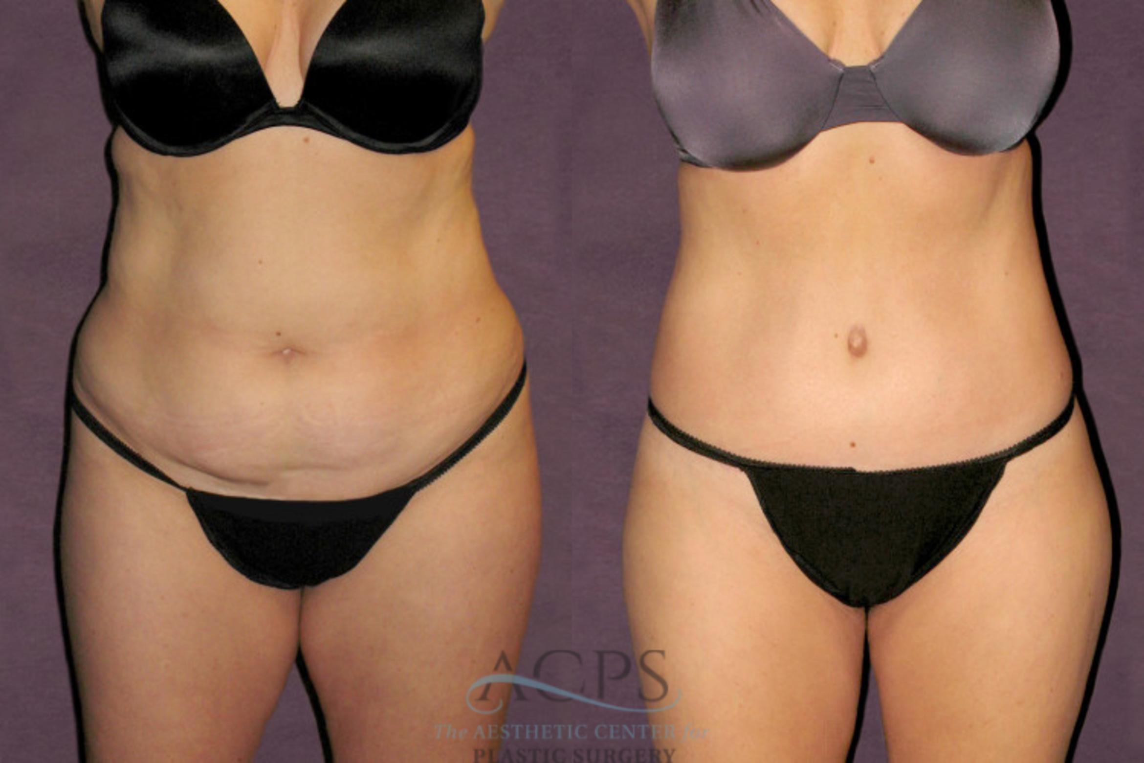 Before & After Tummy Tuck Case 95 Front View: View in Houston, TX