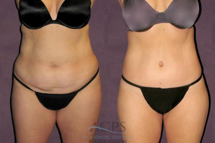 Before & After Tummy Tuck Case 95 Front View: View in Houston, TX