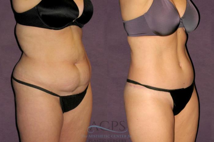 Before & After Tummy Tuck Case 95 Oblique Right View: View in Houston, TX