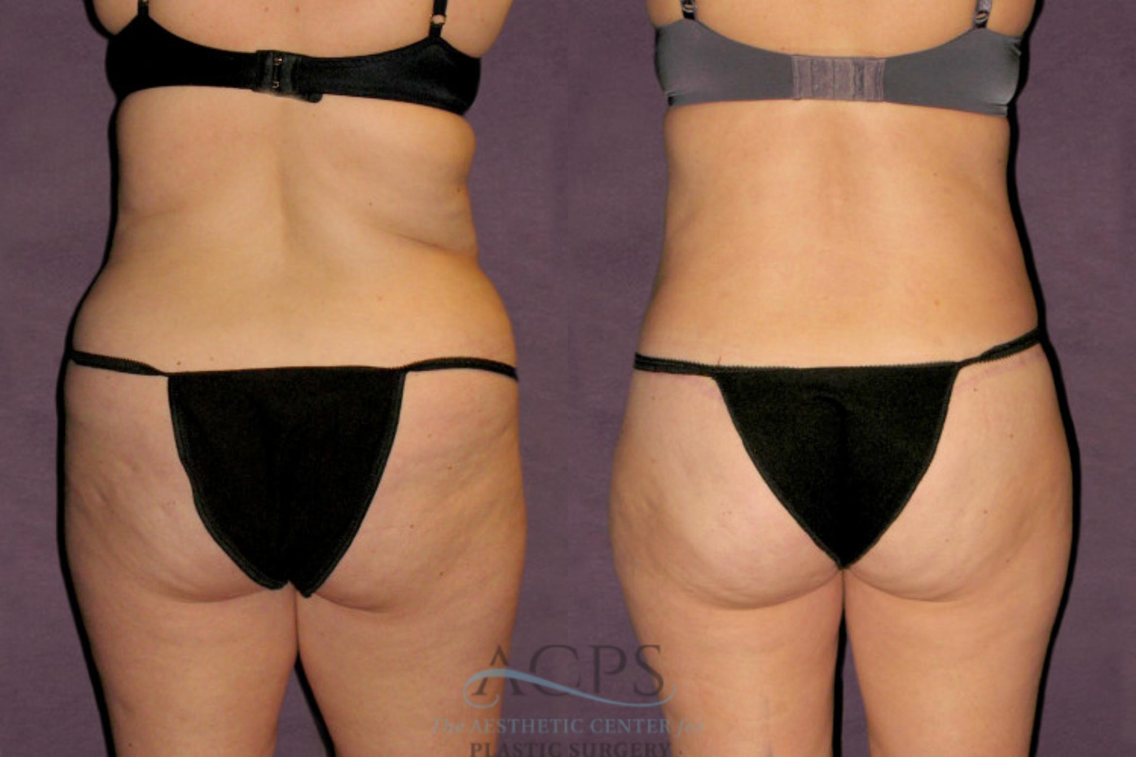Before & After Tummy Tuck Case 95 Rear View: View in Houston, TX
