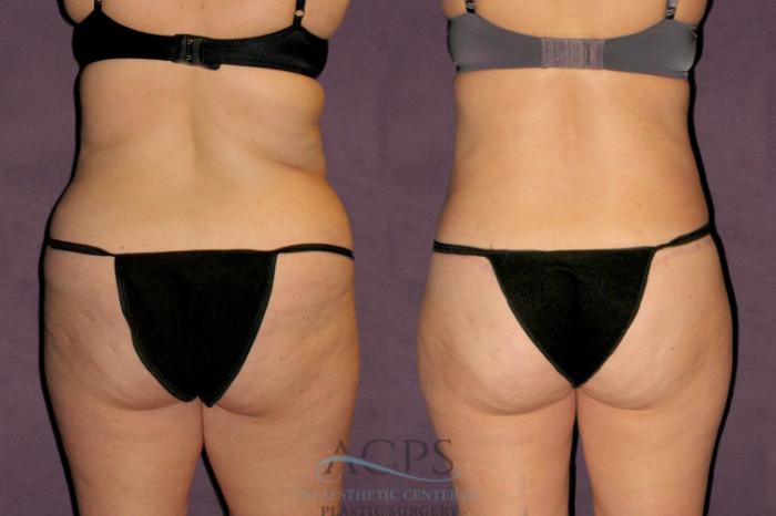 Before & After Tummy Tuck Case 95 Rear View: View in Houston, TX