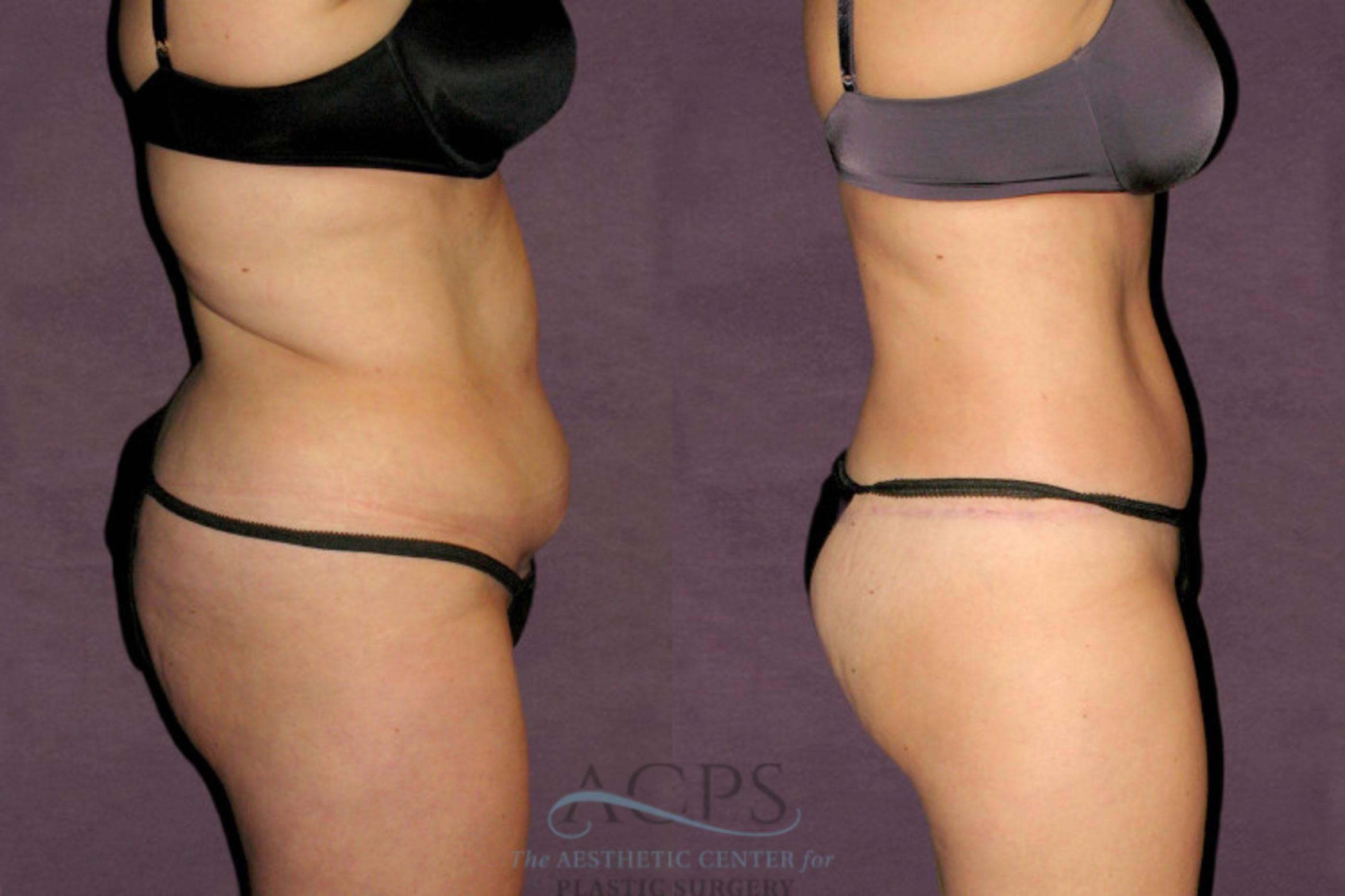 Before & After Tummy Tuck Case 95 Side Right View: View in Houston, TX