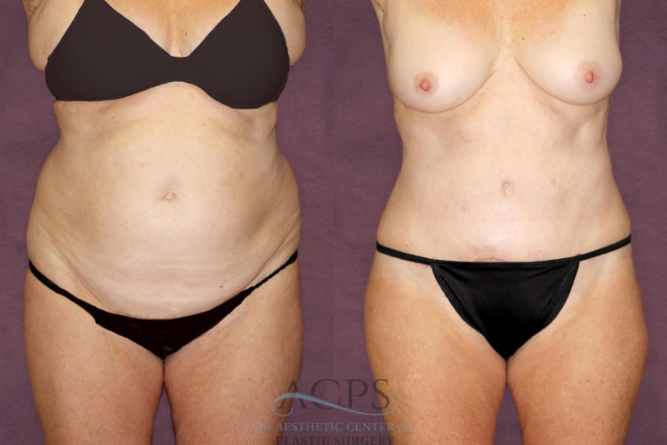 Before & After Tummy Tuck Case 96 Front View: View in Houston, TX
