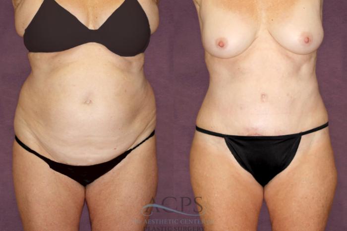 Before & After Tummy Tuck Case 96 Front View: View in Houston, TX