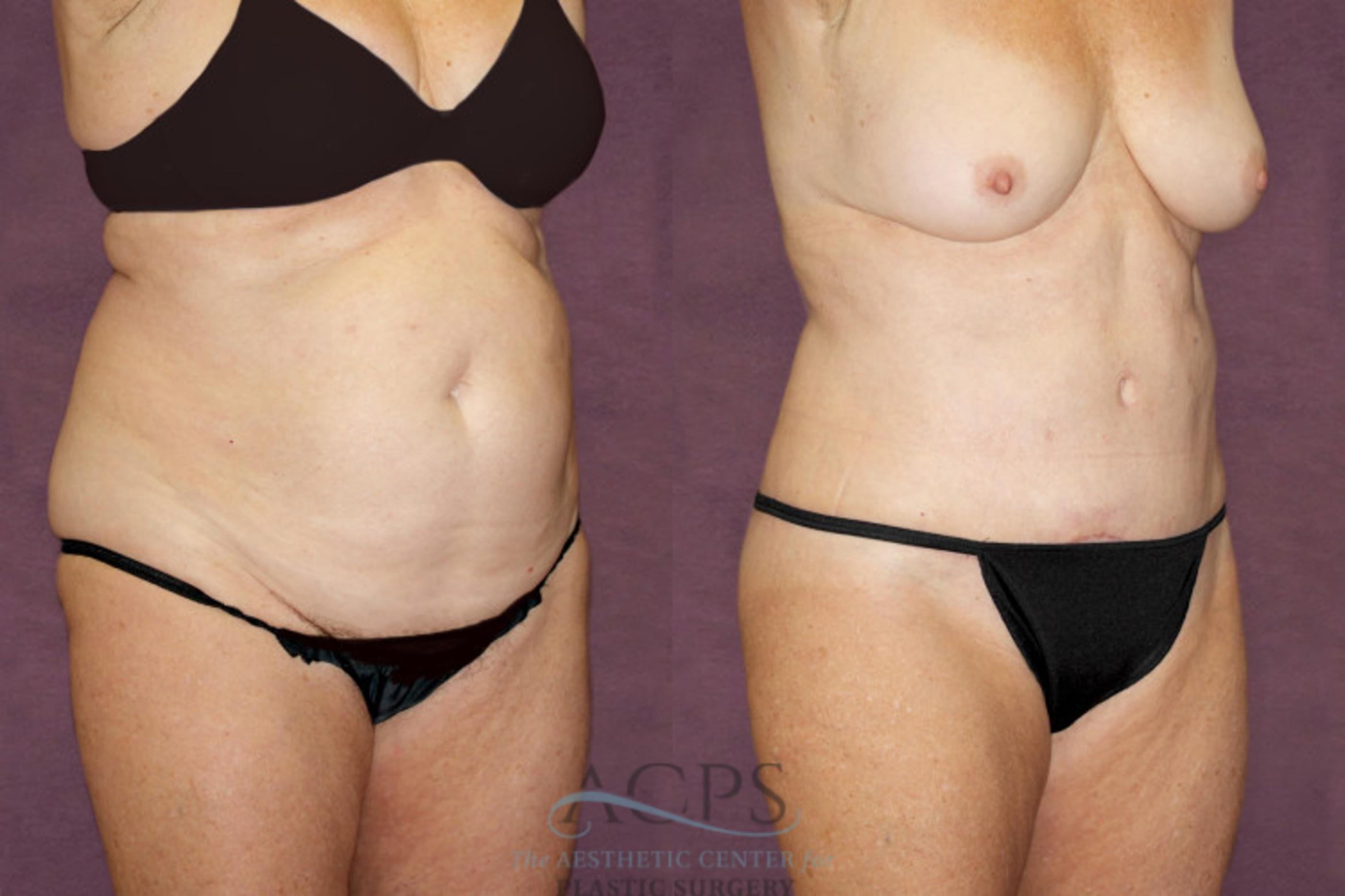 Before & After Tummy Tuck Case 96 Oblique Right View: View in Houston, TX