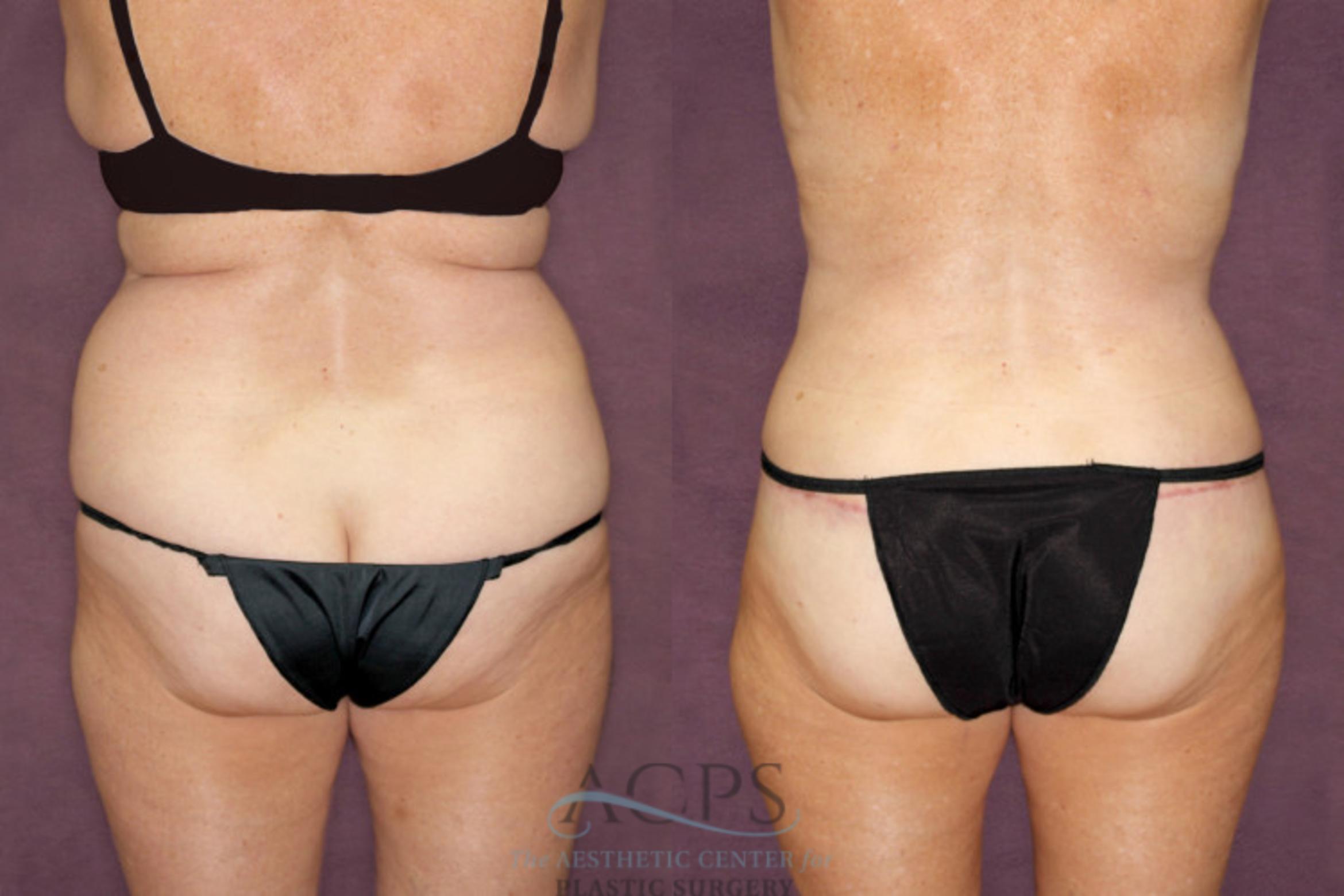Before & After Tummy Tuck Case 96 Rear View: View in Houston, TX