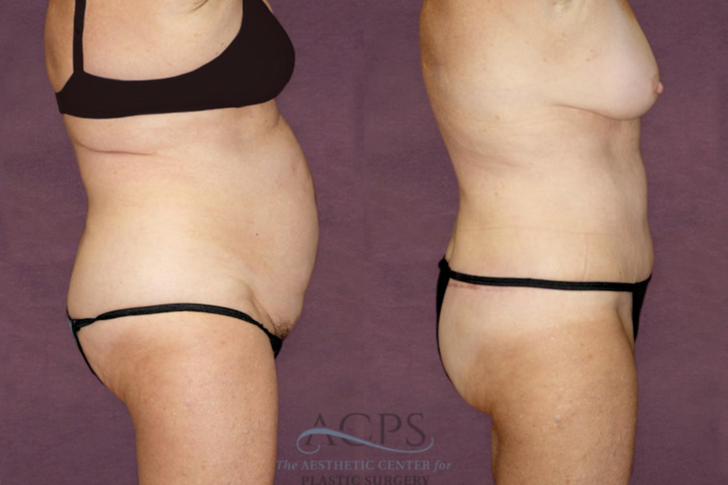 Before & After Tummy Tuck Case 96 Side Right View: View in Houston, TX