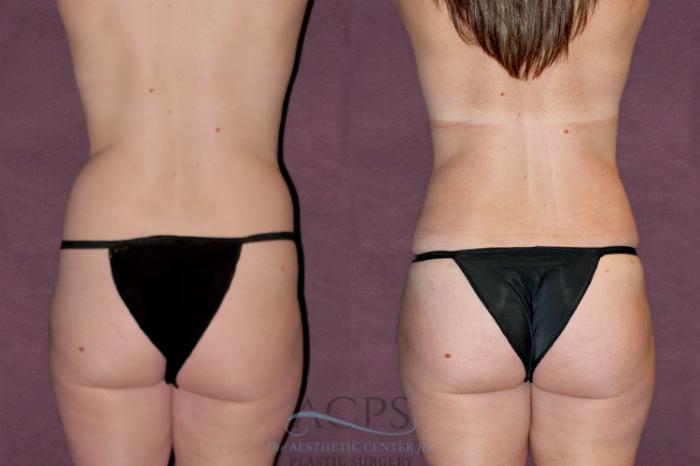 Before & After Tummy Tuck Case 97 Rear View: View in Houston, TX