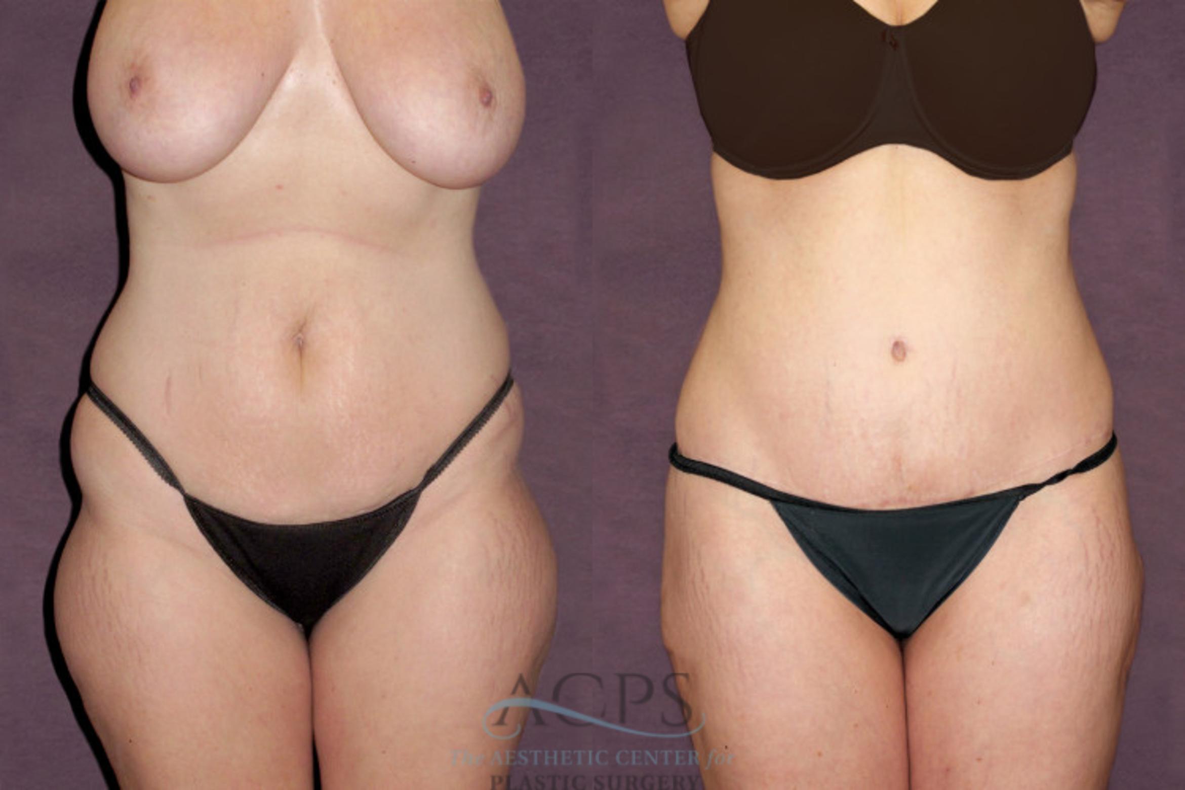 Before & After Tummy Tuck Case 98 Front View: View in Houston, TX