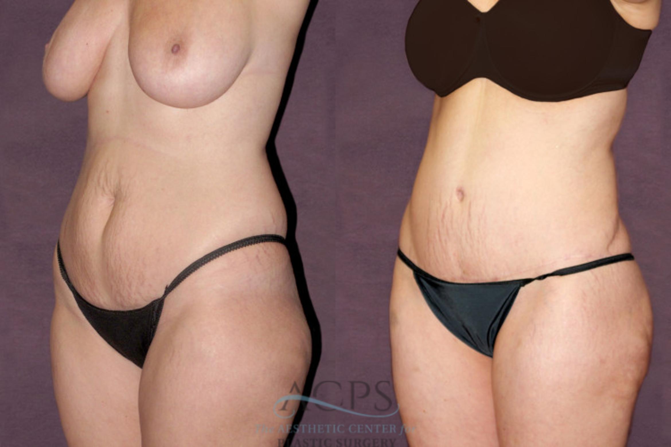 Before & After Tummy Tuck Case 98 Oblique Left View: View in Houston, TX