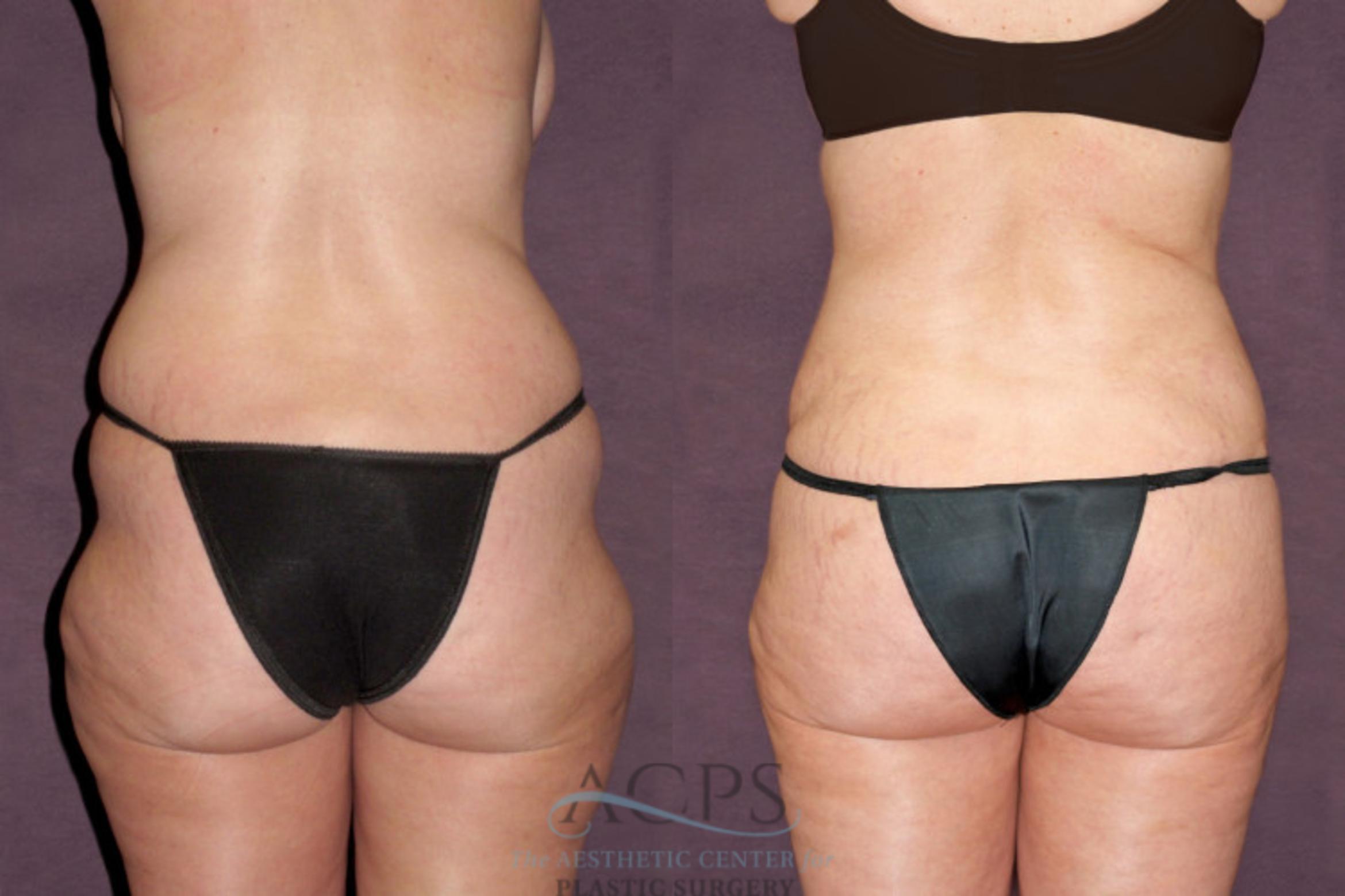 Before & After Tummy Tuck Case 98 Rear View: View in Houston, TX