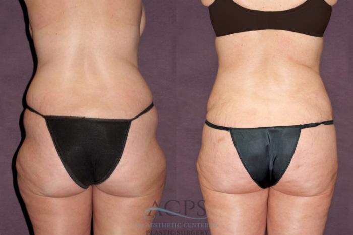 Before & After Tummy Tuck Case 98 Rear View: View in Houston, TX