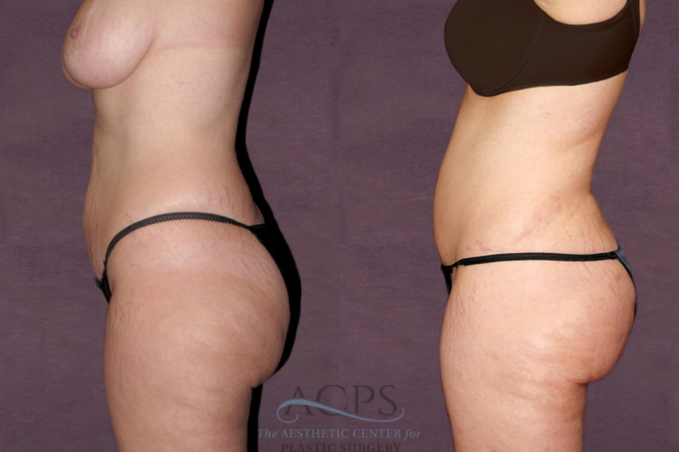 Before & After Tummy Tuck Case 98 Side Left View: View in Houston, TX