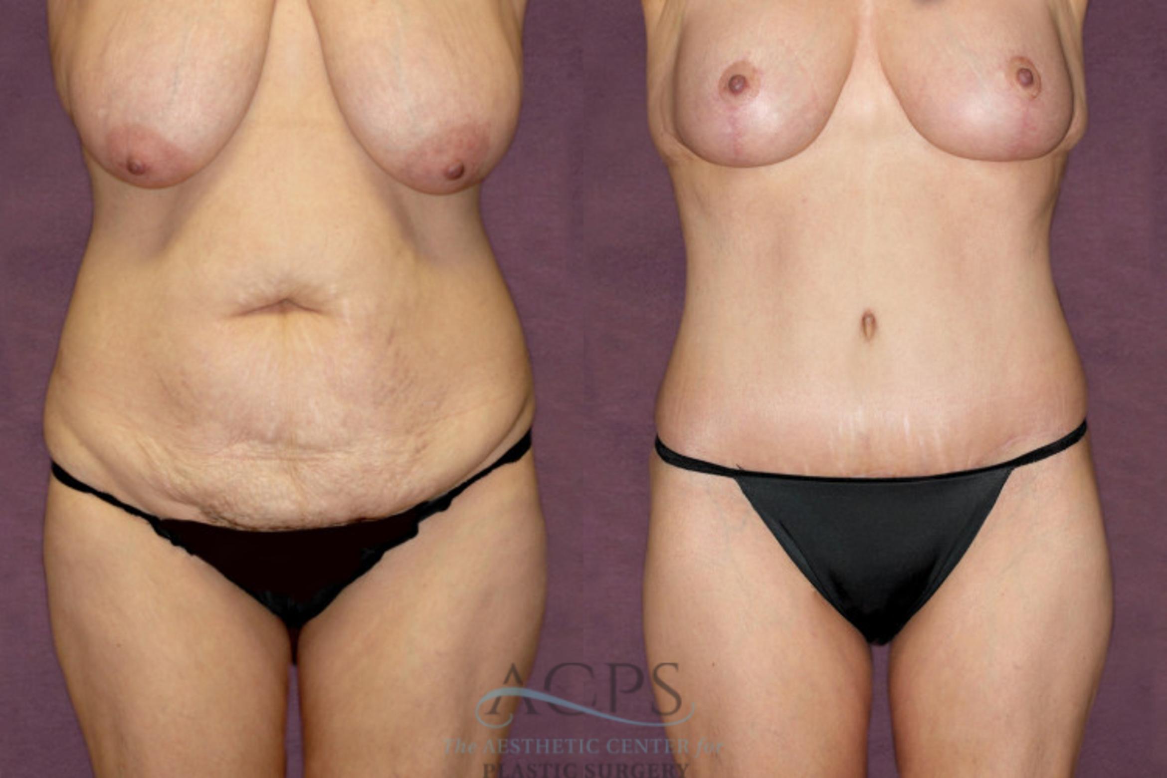 Before & After Tummy Tuck Case 99 Front View: View in Houston, TX