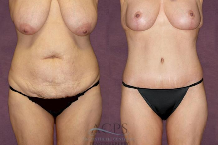 Before & After Tummy Tuck Case 99 Front View: View in Houston, TX