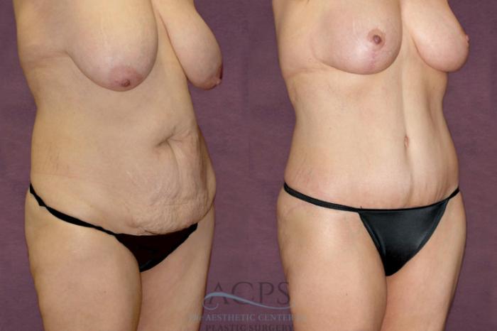 Before & After Tummy Tuck Case 99 Oblique Right View: View in Houston, TX