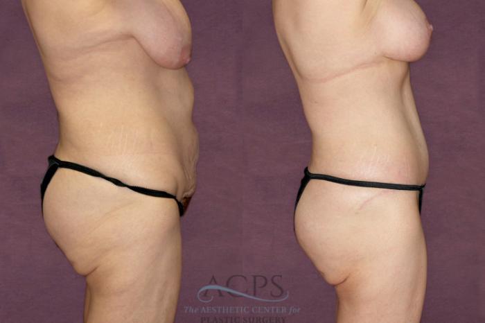Before & After Tummy Tuck Case 99 Side Right View: View in Houston, TX
